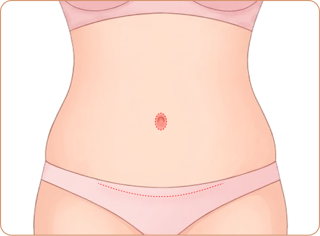 id 病院 - id腹部形成術 - 環状切開(ビキニラインに隠れる切開)