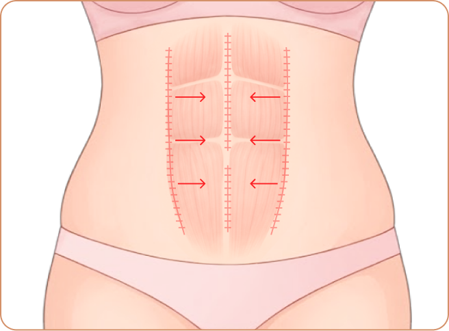 id 病院 - id腹部形成術 - 腹直筋をしっかり修復