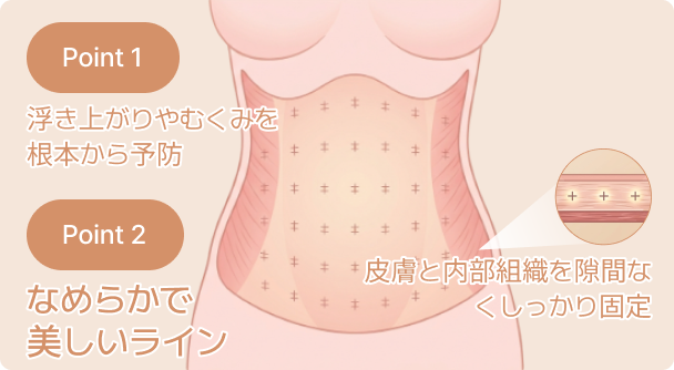 id 病院 - 腹部挙上術 - シームレス固定
