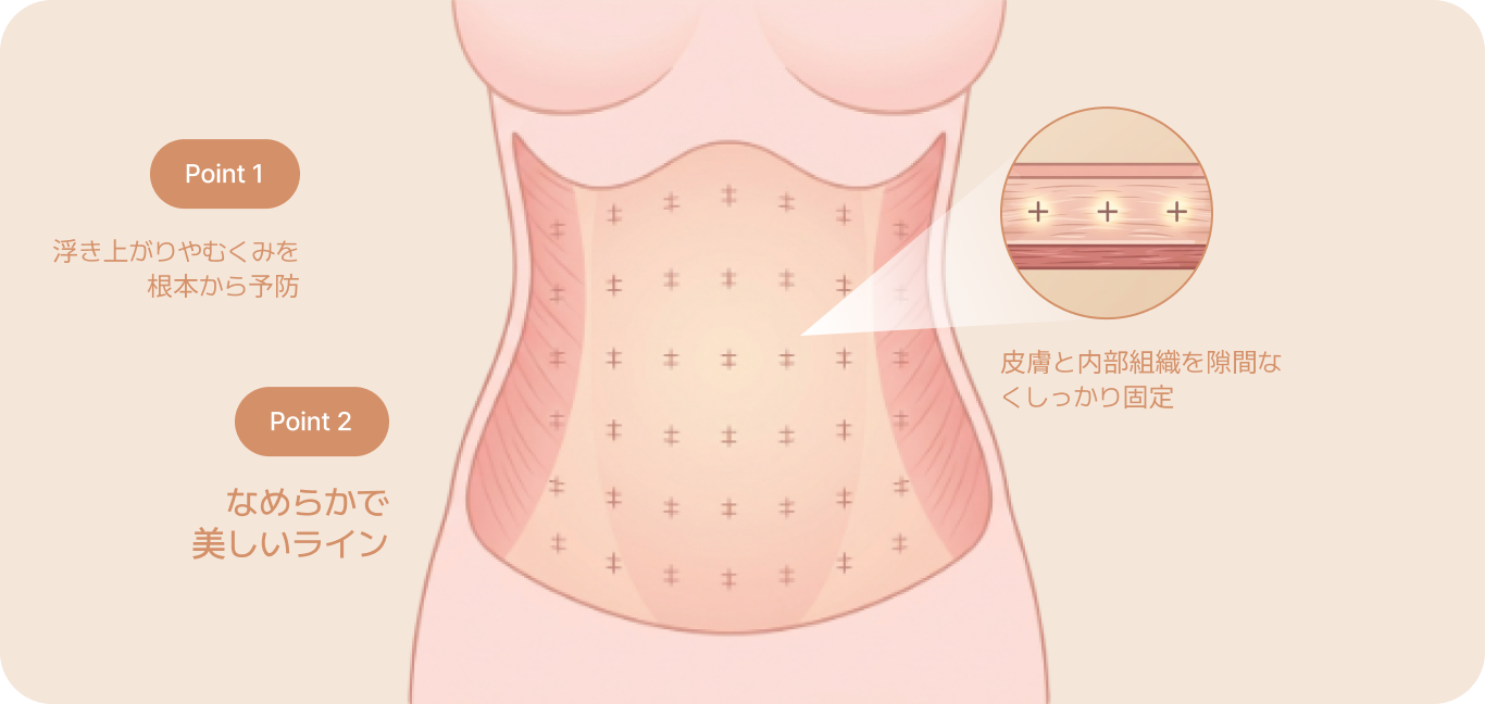 id 病院 - 腹部挙上術 - シームレス固定