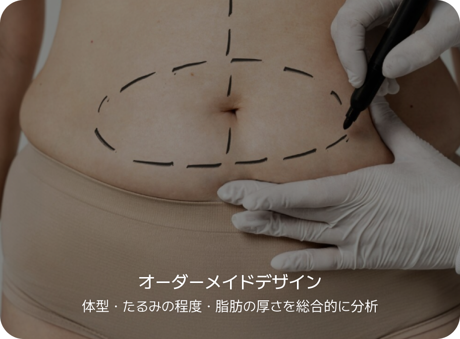 id 病院 - id腹部形成術 - オーダーメイドデザイン