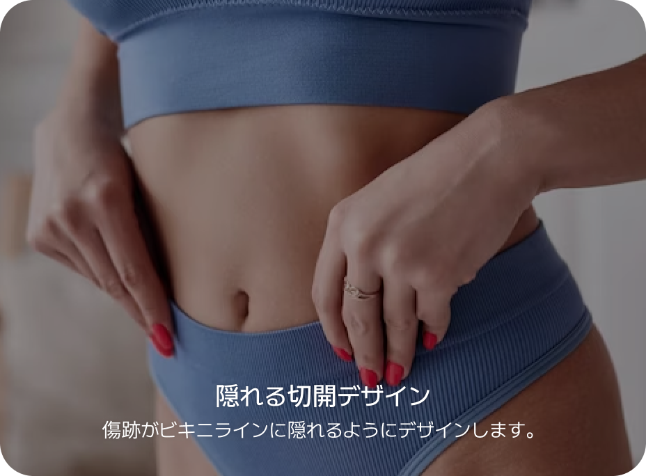 id 病院 - id腹部形成術 - 目立ちにくい切開デザイン