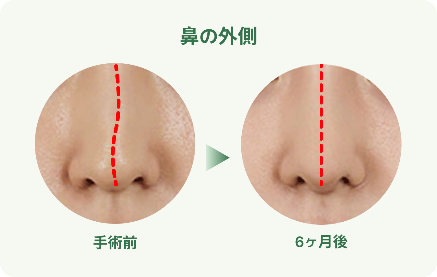 Septoplasty | Functional Rhinoplasty | id Hospital