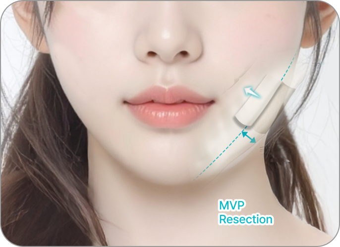 id Hospital - MVP Mandible Reduction - Curved-Line Mandibular Angle Resection