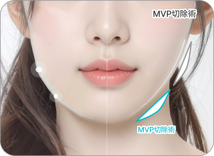 id Hospital - MVP Mandible Reduction - Cortical Bone Resection