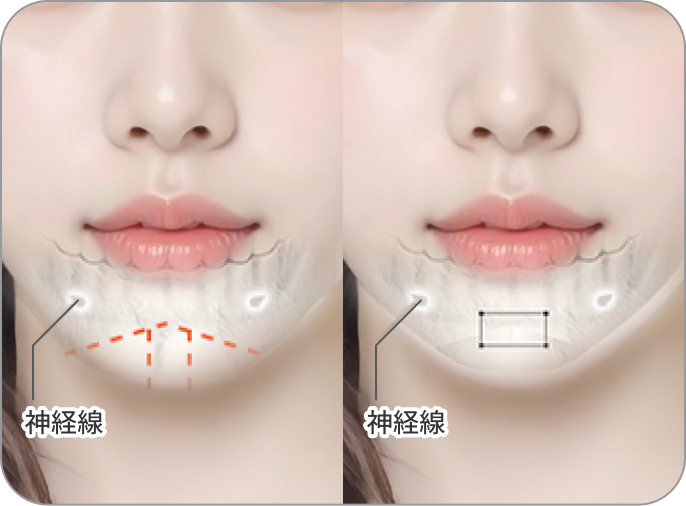 id Hospital - MVP Mandible Reduction - あご先が丸く広い場合