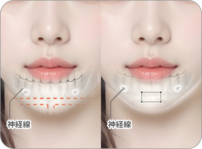 id Hospital - MVP Mandible Reduction - Chin tip is long