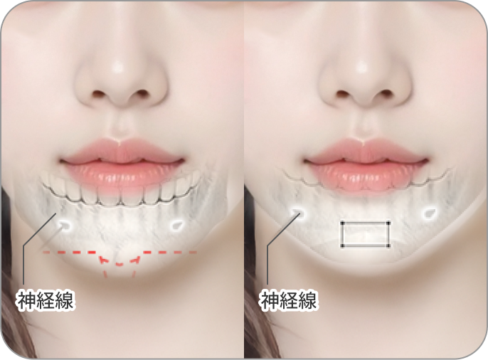 id Hospital - MVP Mandible Reduction - あご先が短く、丸みが強い場合