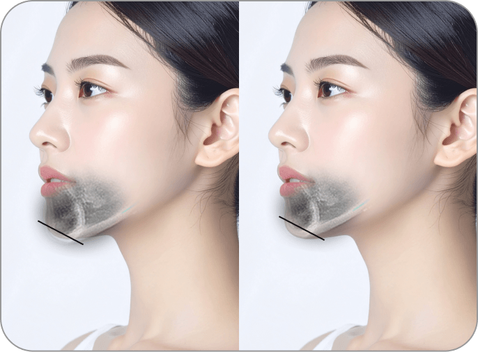 id Hospital - MVP Mandible Reduction - Bite is normal but chin tip is asymmetrical