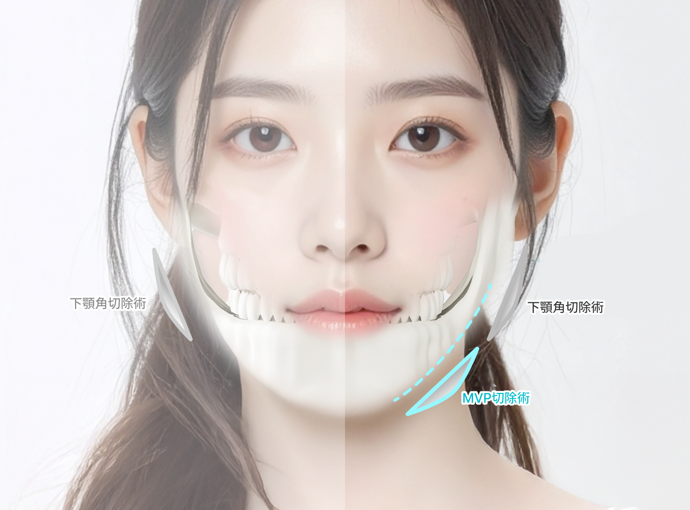 id 病院 - MVPエラ削り - Conventional vs MVP Square Jaw 縮小