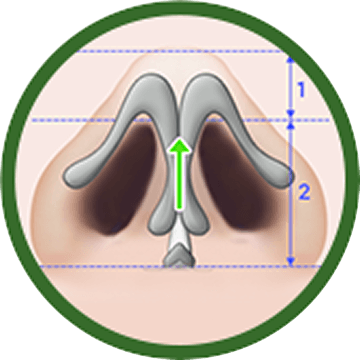 id 病院 - 小鼻縮小 - Improved Nostril Proportion 手術後
