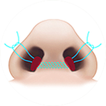id 病院 - 小鼻縮小 - Nostril -縫合 手術前