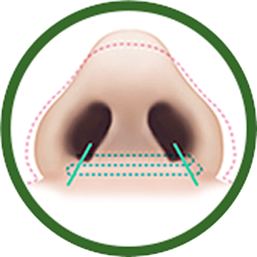 id 病院 - 小鼻縮小 - Nostril -縫合 手術後